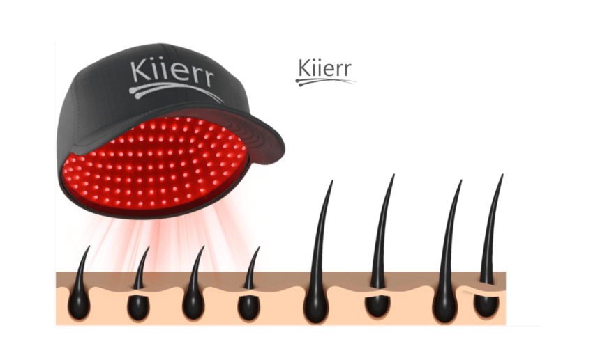 Is This Laser Technology the Biggest Breakthrough in Hair Loss?