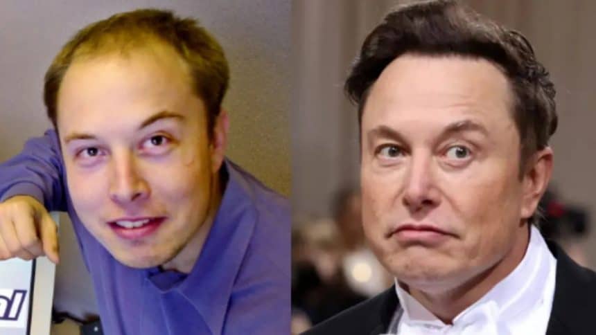 What's the Secret Behind Elon Musk's Hair Transplant?